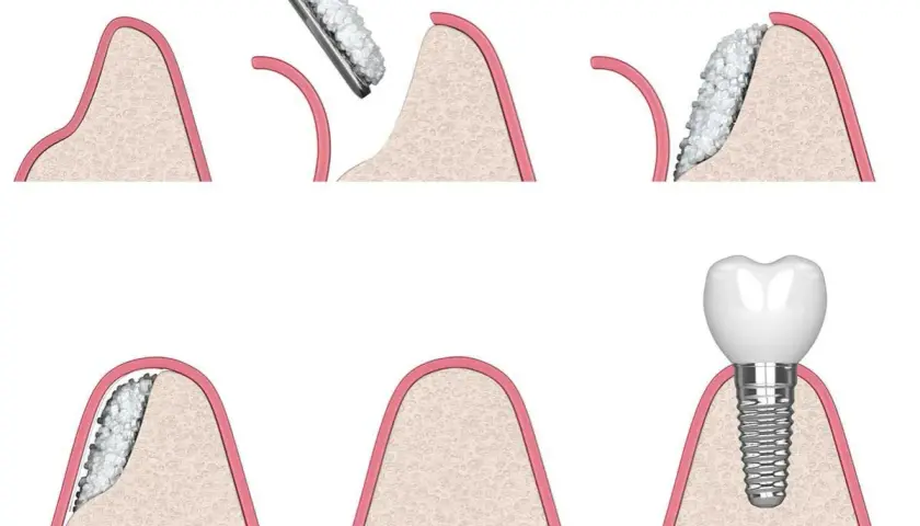 Illustrazione delle fasi di un innesto osseo dentale: preparazione, aggiunta di materiale osseo e inserimento dell'impianto.