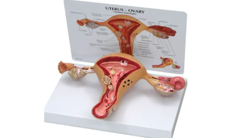 Model anatomiczny narządu rodnego z widoczną torbielą na jajniku.