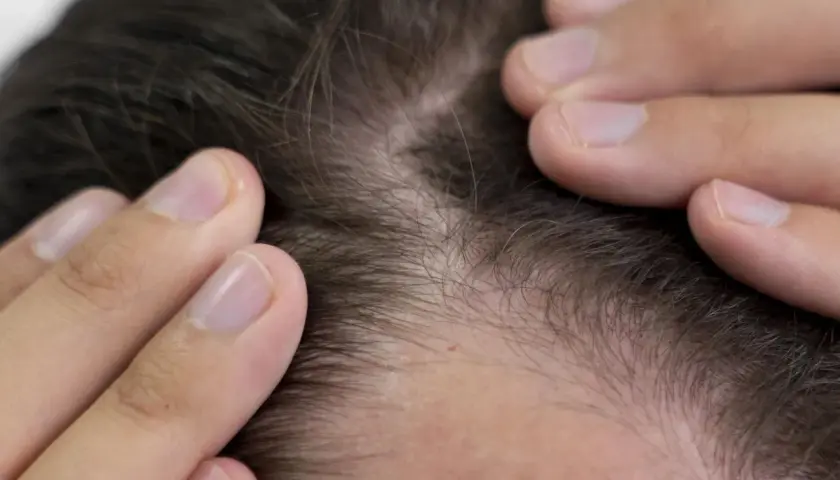 Manos revisando el cuero cabelludo, observando el ciclo cabello y su posible debilitamiento.