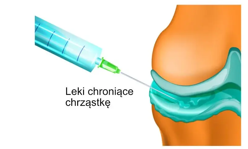 Jakie leki na zwyrodnienie stawu kolanowego skutecznie łagodzą ból?