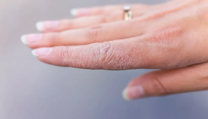 En hand med torr, spruckna fingertoppar. En ring syns på ett finger.
