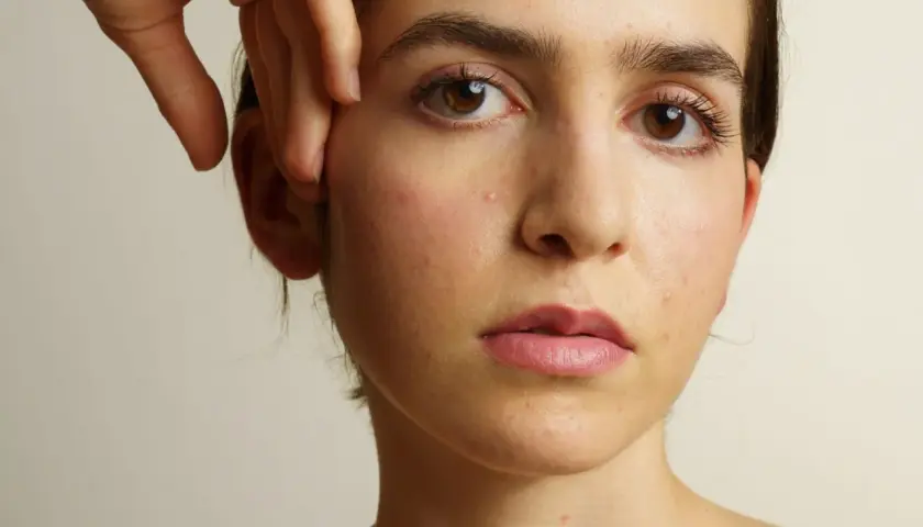 Visage d'une jeune femme aux yeux marron, présentant des rougeurs et des imperfections cutanées, évoquant l'acné et la ménopause.