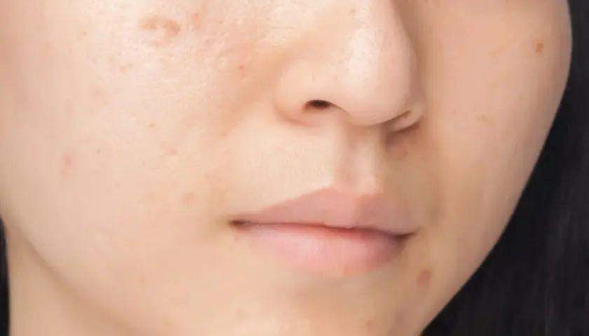 Närbild på en persons ansikte med synliga pigmentfläckar och ojämnheter i melanin hud.