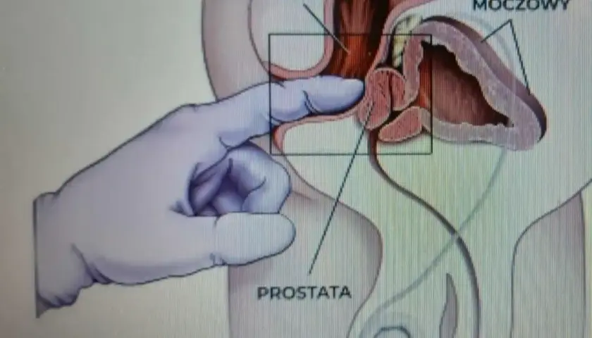Anatomical illustration showing a gloved finger performing a prostate massage through the rectum.