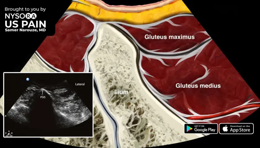 Anatomía de la pelvis y glúteos, mostrando el ilion, glúteo mayor y medio. Ecografía de la zona del PSIS y sacro, útil para diagnosticar el síndrome piriforme.