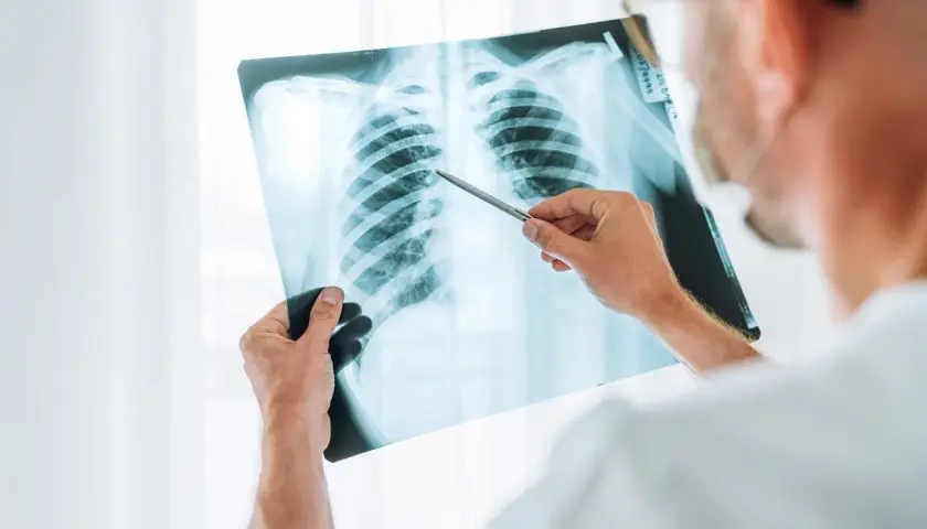 Medico esamina radiografia polmonare, evidenziando un caso di polmonite nosocomiale e valutando il potenziale risarcimento.