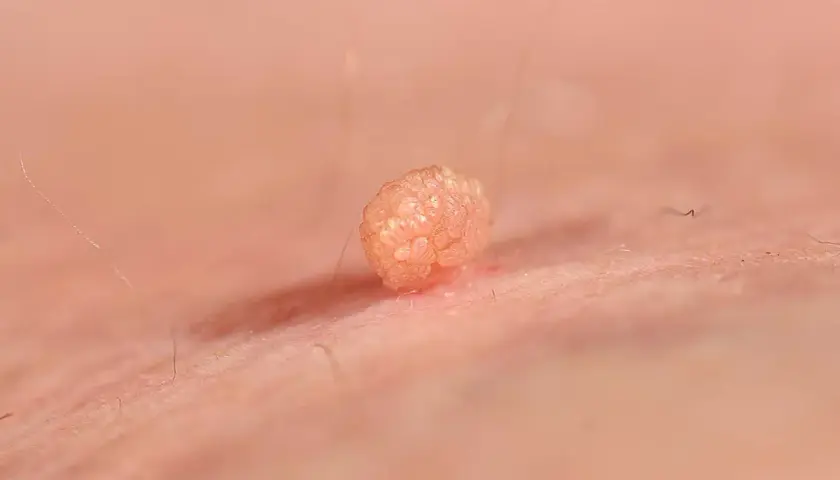 Broczawka, jeden z objawów wirusa HPV, widoczna z bliska na skórze.