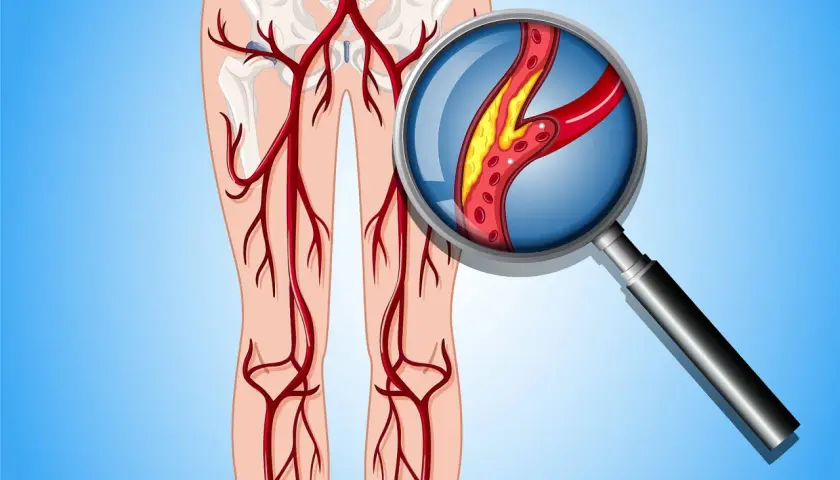 Wichtige Diagnosetechniken der peripheren arteriellen Verschlusskrankheit