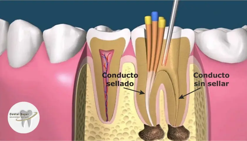 Ilustración de un diente mostrando un conducto radicular sellado y otro sin sellar, con instrumentos dentales. Esto explica qué es una reendodoncia.