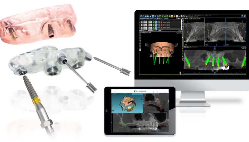 Componenti per chirurgia guidata dentale: guide, impianti e software di pianificazione 3D.
