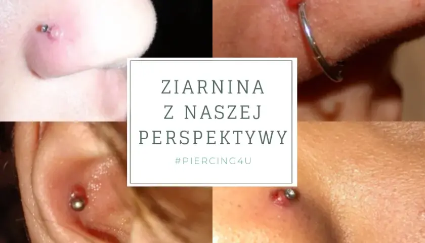 Infekcja kolczyka w pępku: Jak rozpoznać objawy i skutecznie leczyć?