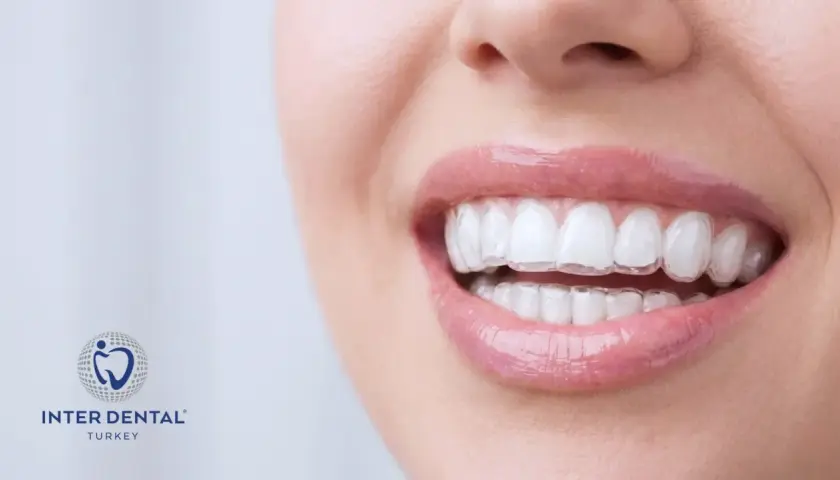 Uśmiechnięta kobieta z dyskretnymi, przezroczystymi nakładkami na zęby. Inter Dental Turkey oferuje estetyczne rozwiązania dla pięknego uśmiechu.