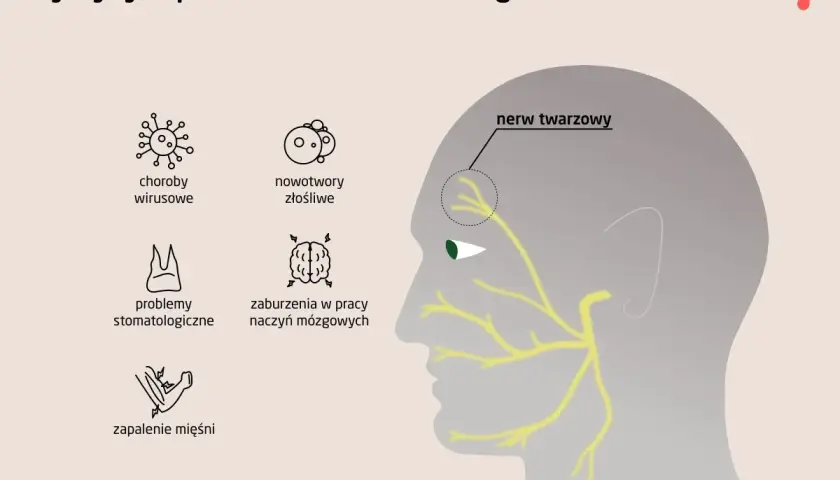 Ilustracja przedstawia schematyczne przyczyny zapalenia nerwu twarzowego: choroby wirusowe, nowotwory, problemy stomatologiczne, zaburzenia naczyń mózgowych i zapalenie mięśni.