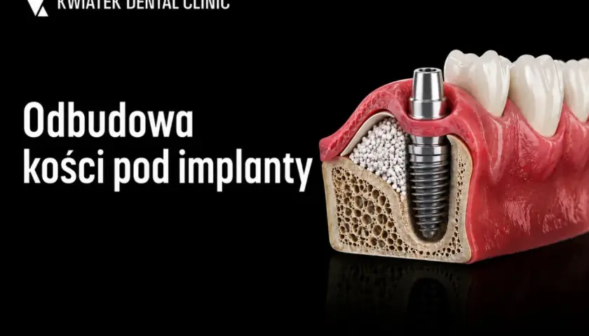 Model szczęki z implantem i materiałem do augmentacji kości. Kwiatek Dental Clinic.