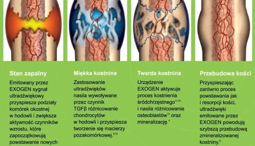 Ilustracja pokazuje etapy zrostu kości: stan zapalny, miękką i twardą kostninę, a na końcu przebudowę kości.