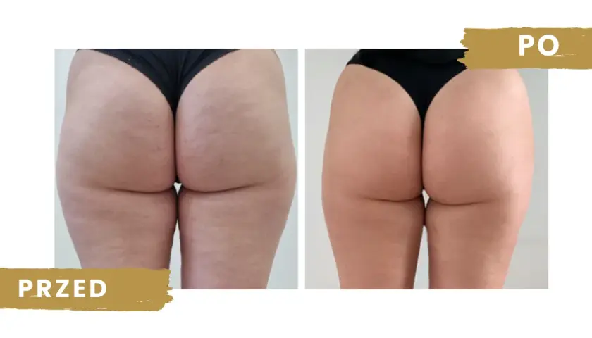 Endermologia: na czym polega? Przewodnik po zabiegu i efekty!