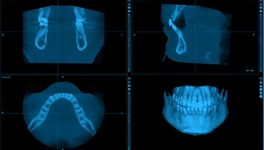 Trzy widoki badania CBCT szczęki i żuchwy, w tym widok 3D.