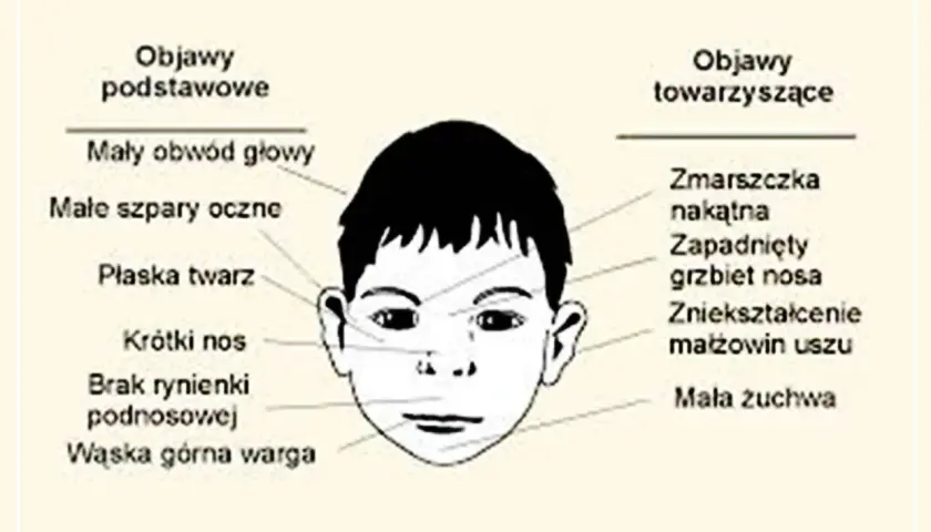 Ilustracja twarzy dziecka z zaznaczonymi cechami, jak mały obwód głowy, płaska twarz, krótki nos, wąska warga, zmarszczka nakątna, zapadnięty grzbiet nosa, zniekształcenie małżowin uszu, mała żuchwa. To mogą być objawy z zespołu FAS.