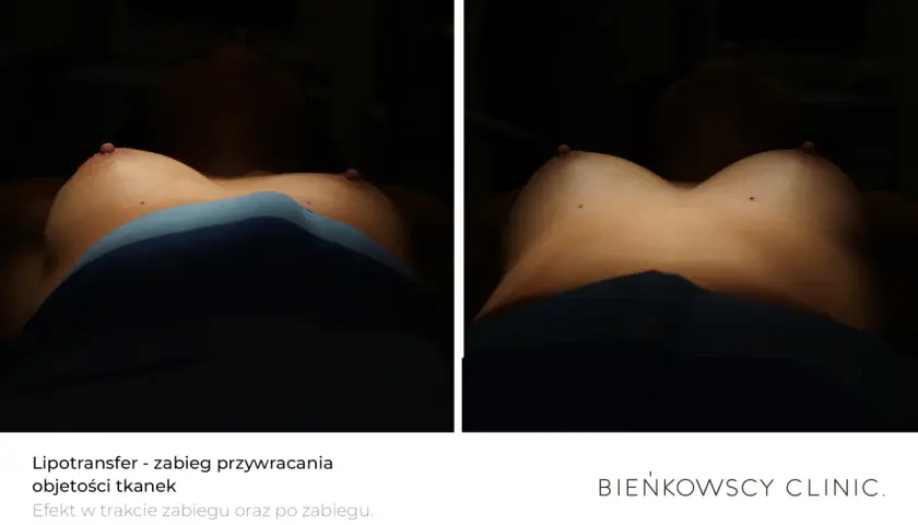 Trwałość lipofillingu biustu: Ile tłuszczu zostanie z Tobą na lata?