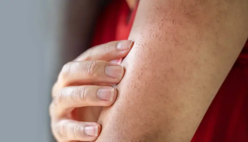 En hand undersöker en arm med en knottrig panna, troligen ett utslag eller torr hud.