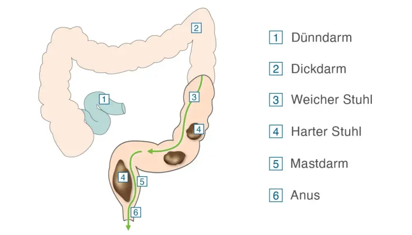 Darstellung des Verdauungstrakts. Harter Stuhl (4) im Dickdarm (2) kann eine Verstopfung lösen, bevor er den Mastdarm (5) erreicht.