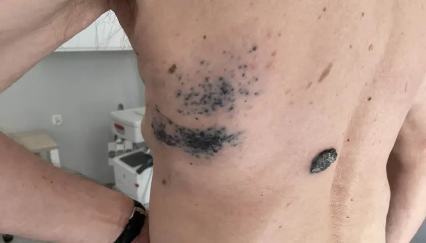 Niepokojące objawy czerniaka - poznaj pierwsze sygnały ostrzegawcze skóry