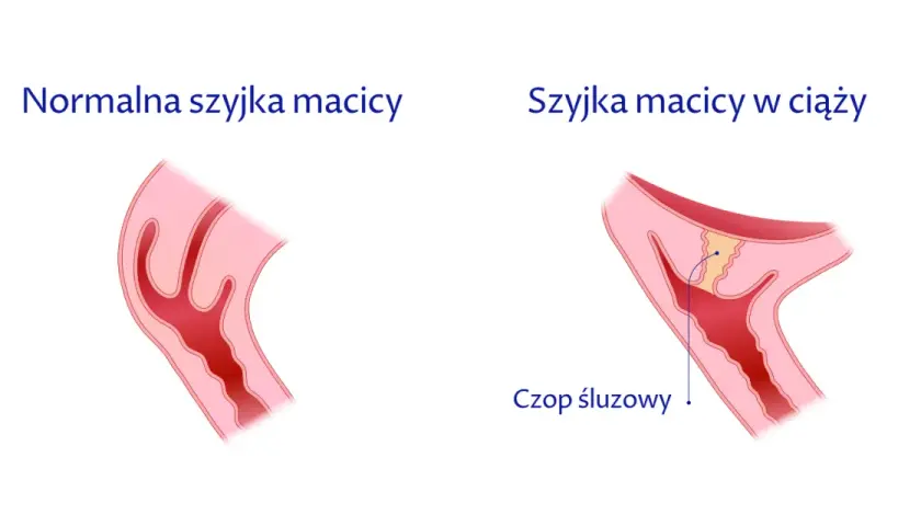 Jak skutecznie zapobiec skracaniu szyjki macicy w ciąży i uniknąć zagrożeń