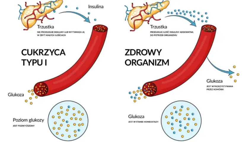 Skąd się bierze cukrzyca? Poznaj zaskakujące przyczyny i czynniki ryzyka