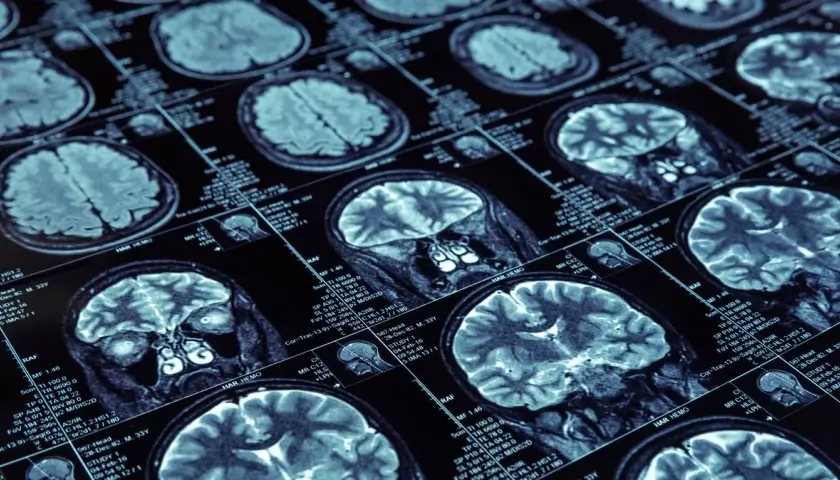Jak zapobiec Alzheimerowi: skuteczne metody ochrony zdrowia mózgu