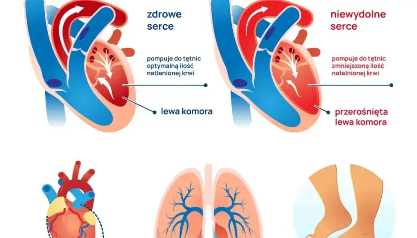 Niewydolność serca objawy: co musisz wiedzieć o duszności i zmęczeniu