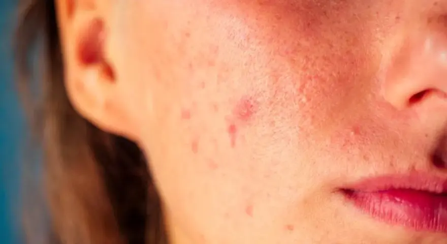 Pryszcz który nie znika: co oznacza i kiedy iść do dermatologa