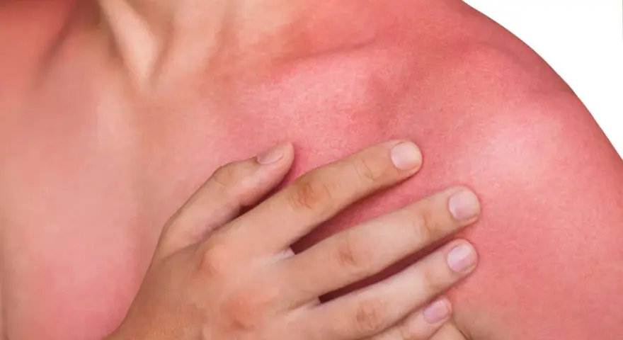 En person med kraftigt solbränd, röd hud på axlar och bröst. Känns som att vara allergisk mot solen.