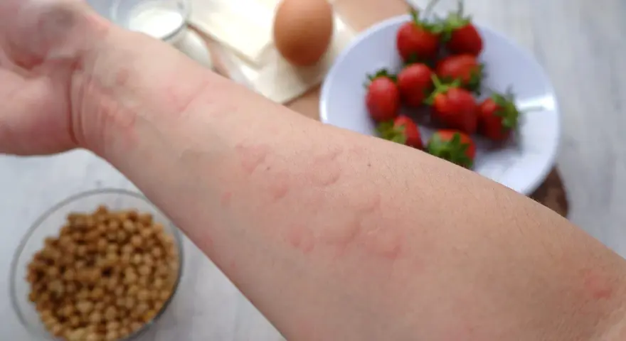 Ręka z wysypką, objawem alergii pokarmowej. W tle truskawki, jajko i nasiona.
