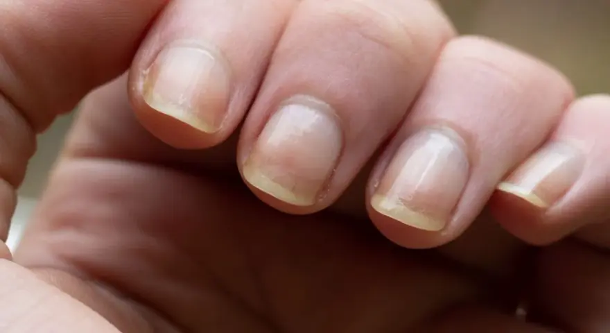 Gros plan sur des doigts montrant un ongle jaune, signe possible d'une mycose ou d'une autre affection.