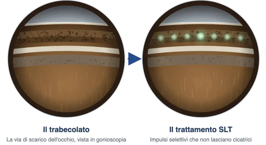 Trabeculoplastica laser selettiva: prima e dopo il trattamento SLT. Impulsi laser che migliorano il drenaggio oculare, minimizzando i rischi di cicatrici.