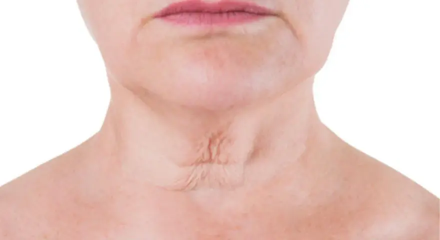 Primer plano del cuello de una mujer, mostrando arrugas en el cuello y la piel con pecas.