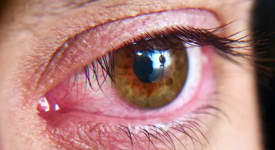 Occhio arrossato e irritato, possibile sintomo di sindrome dell'occhio secco cause.