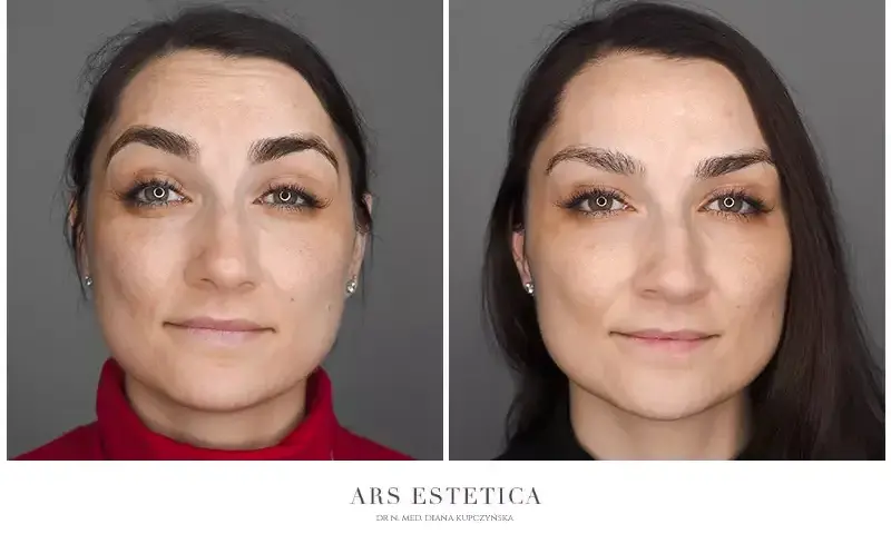 Ile jednostek botoksu na czoło? Dawka, koszt i efekty