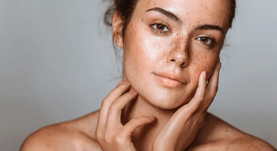 Visage d'une jeune femme aux taches brunes naturelles, ses mains caressant délicatement sa peau.