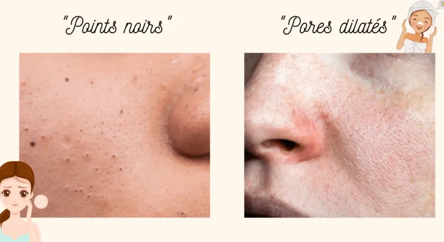 Gros plan sur la peau : points noirs d'un côté, et de l'autre, une zone avec des pores dilatés, suggérant un traitement.