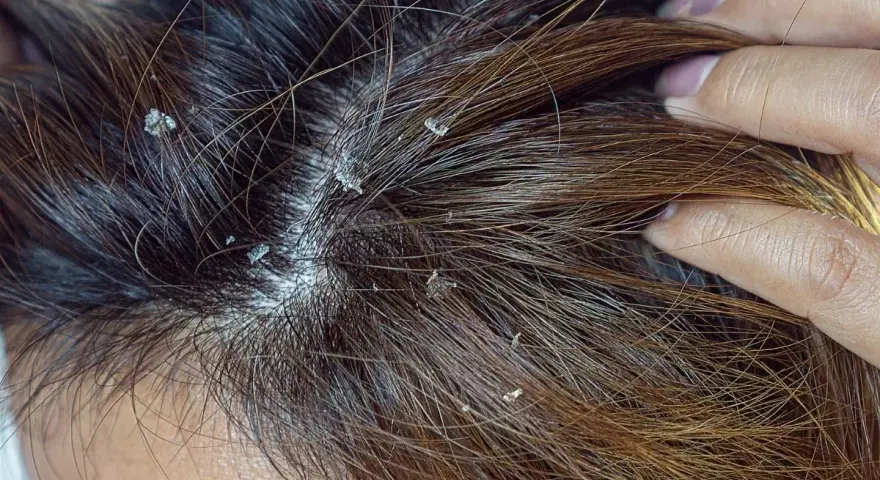 Widoczne białe płatki na ciemnych włosach. Czy to łupież? Dowiedz się, dandruff co to jest i jak sobie z nim radzić.
