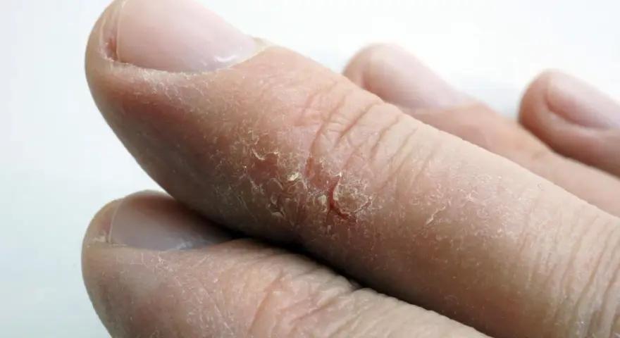 Gros plan sur des doigts aux bouts secs, la peau craquelée et desquamée.