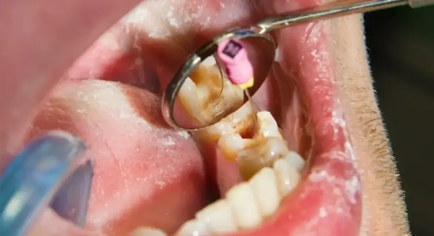 Dentysta wykonuje leczenie kanałowe martwego zęba, używając narzędzi widocznych w lusterku stomatologicznym.
