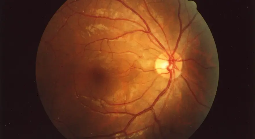 Il fundus oculi cos'è? Un'immagine della retina con vasi sanguigni rossi e aree biancastre, rivelando la sua complessa struttura interna.