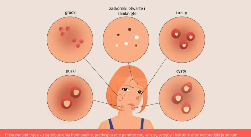Ilustracja przedstawia różne rodzaje trądziku: grudki, zaskórniki, krosty, guzki i cysty.