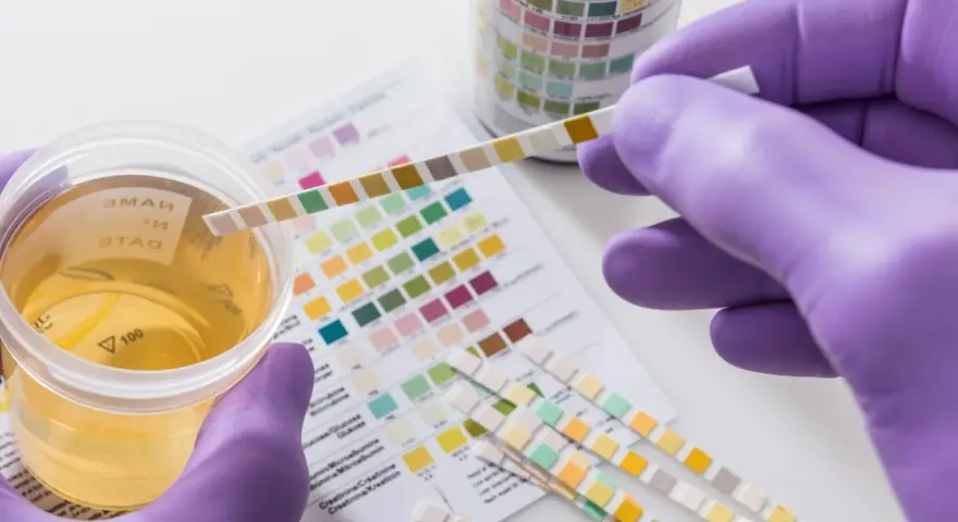 Urinprobe mit Teststreifen zur Analyse. Mögliche erhöhte Leukocyten im Urin werden durch Farbveränderungen auf dem Teststreifen angezeigt.