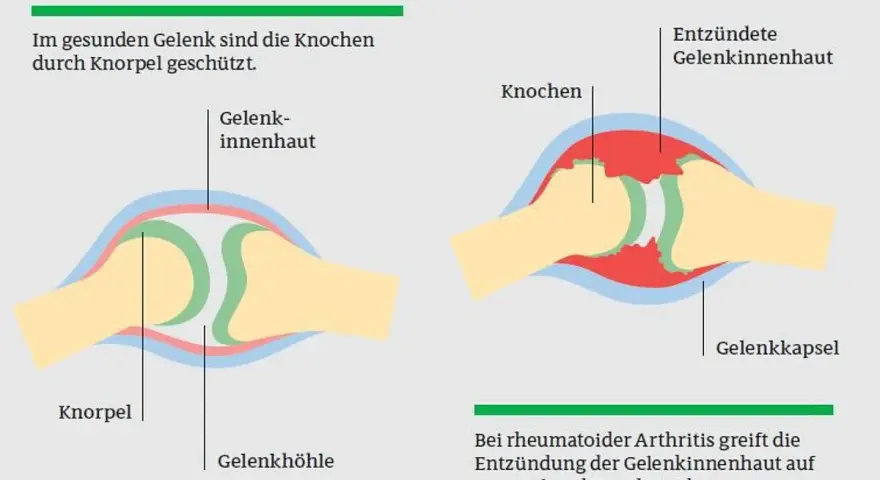 Die häufigsten Symptome der rheumatoiden Arthritis und ihre Folgen