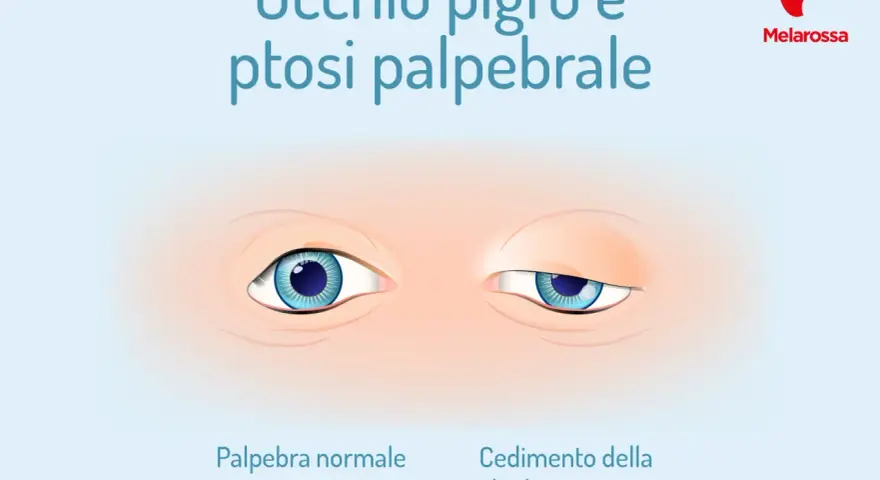 Occhio pigro e ptosi: confronto tra palpebra normale e cedimento. Ambliope cosa significa?