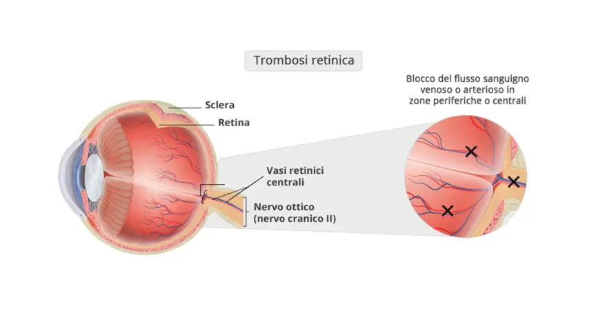 Diagramma occhio: trombosi retinica con blocco flusso sanguigno. Sintomi visivi possono manifestarsi in zone periferiche o centrali.