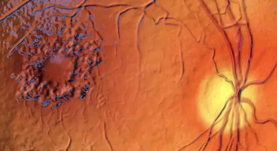 Edema maculare cistoide: la macula appare gonfia e irregolare, con aree scure che suggeriscono le cause. Vasi sanguigni retinici visibili.